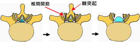 腰部脊柱管狭窄症の手術的治療について 京都の腰痛クリニック 渡辺整形外科