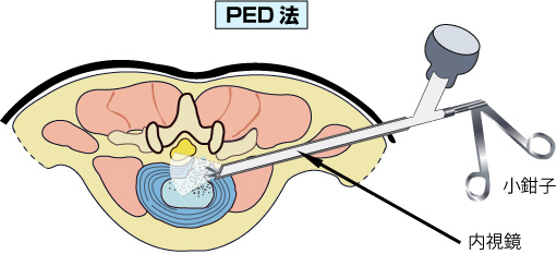 Peld法 Ped法 について 京都腰痛専門クリニック わたなべ整形外科